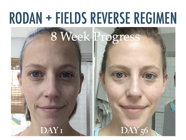 rodan and fields acne treatment reviews